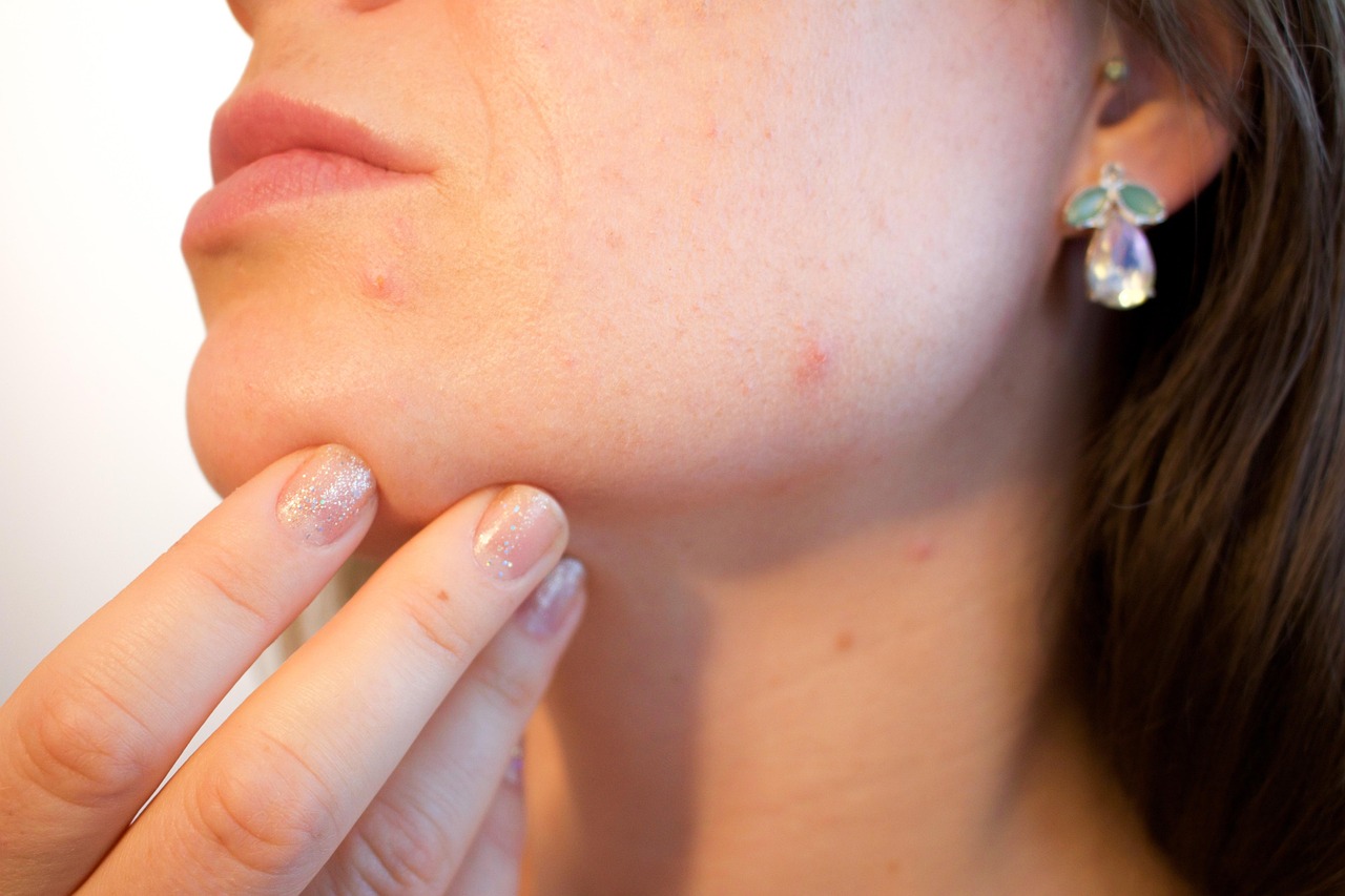 how to calm acne without damaging skin barrier visual guide for readers
