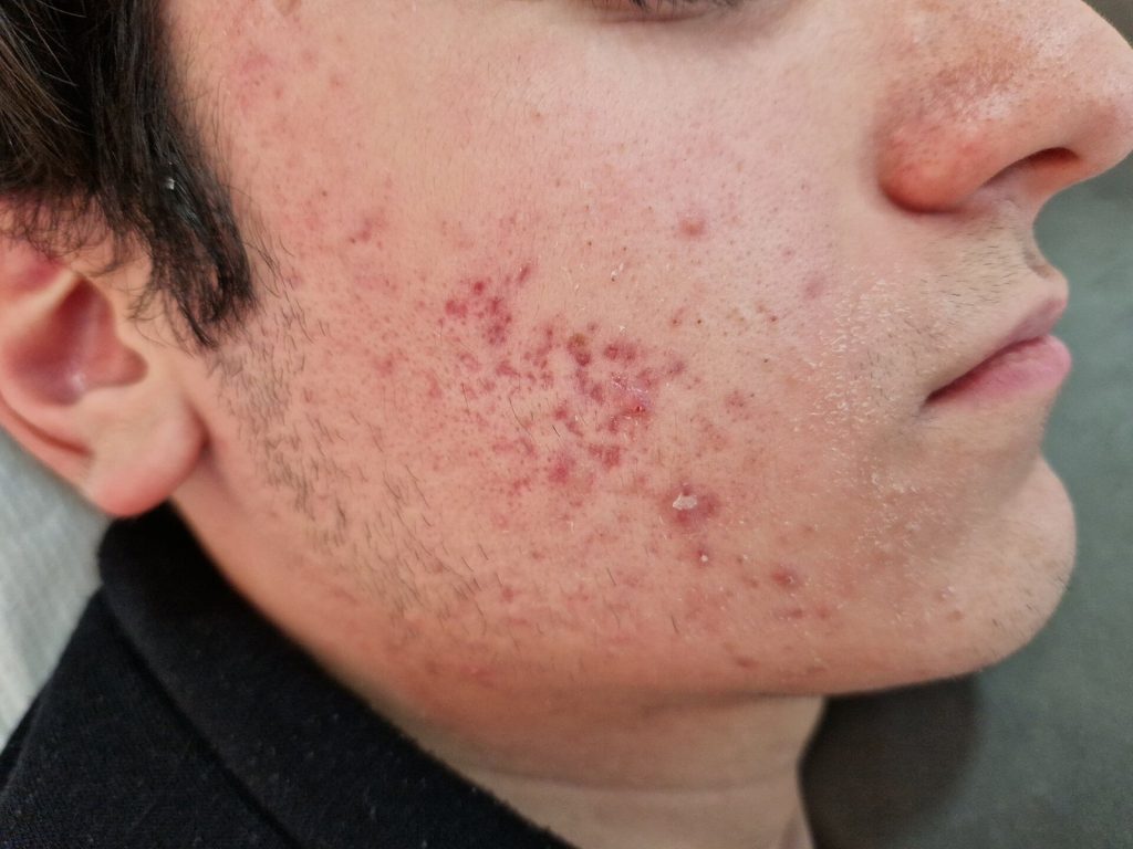 Close-up of a person’s cheek and jawline with visible acne lesions and post-inflammatory redness